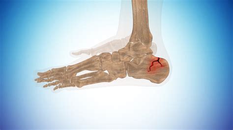 Types Of Calcaneus Fracture Or Broken Heel Youtube