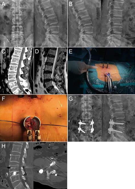 Frontiers Comparison Of Postoperative Outcomes Between Percutaneous
