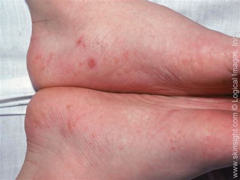 What Is Dyshidrotic Eczema How To Identify And Treat