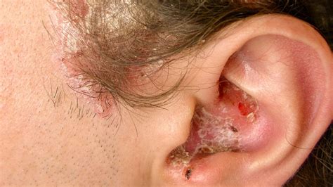 Managing Psoriasis Behind The Ear Tips For Relief And Prevention