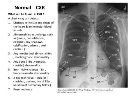 Medical Online Normal Chest X Ray Interpretation Facebook
