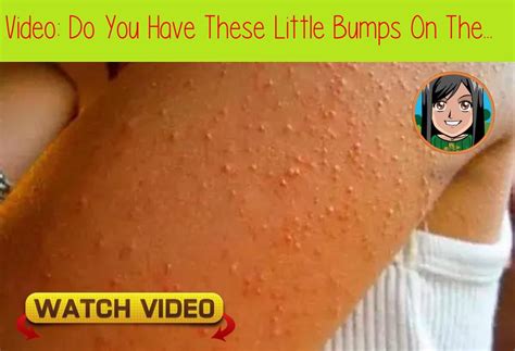 Do You Have These Little Bumps On The Arms See Why They