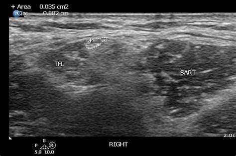 Cureus Lateral Femoral Cutaneous Nerve Decompression Guided By