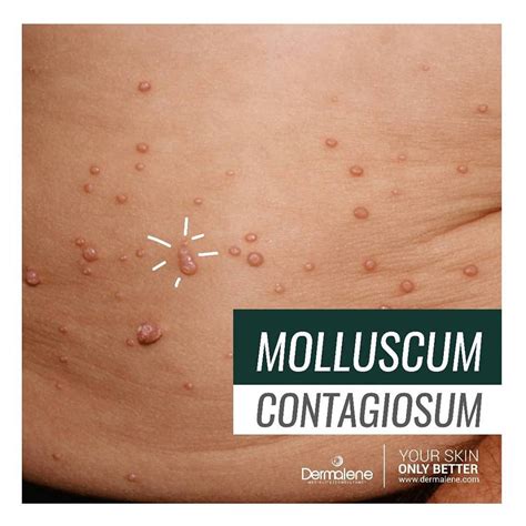 Molluscum Contagiosum Dermalene