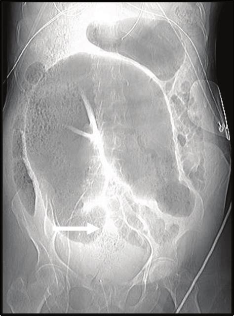 Ap Radiograph Of The Abdomen And Pelvis Of Patient With Constipation