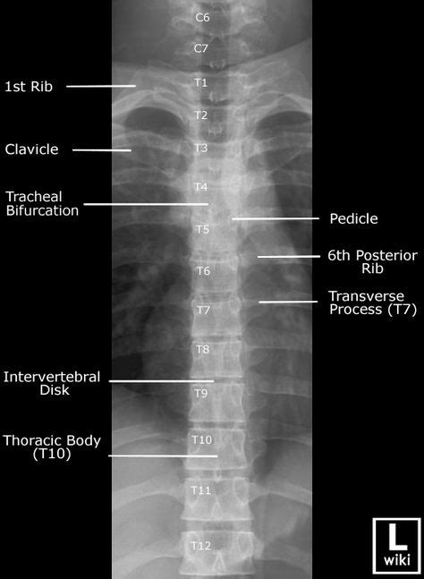Frontal Radiograph Of The Thoracic Spine With Labels Excalibur