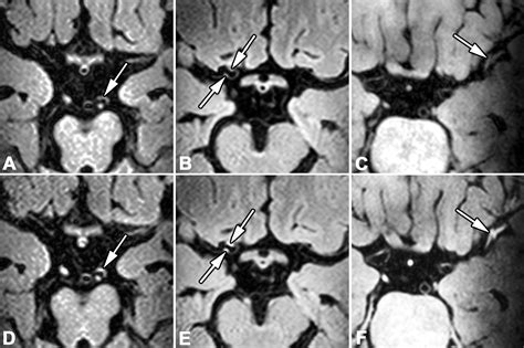 Intracranial Atherosclerosis Assessed With 7 T Mri Evaluation Of