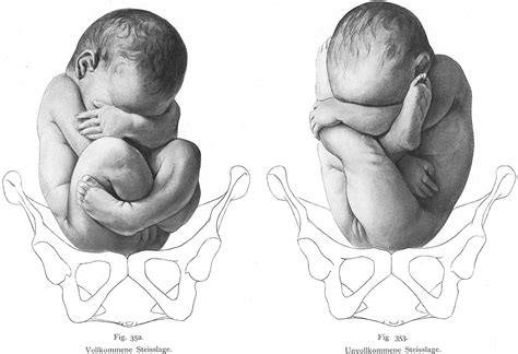 Fetal Positions Can Affect Childbirth Most Cause Cesarean Birth