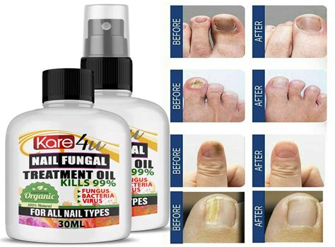 Ml Fungal Nail Treatment Highly Effective Kill Nail Fungus For Best