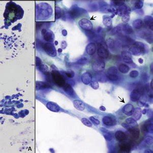 Cancer cells in biological tissues sometimes behave like customers in a bar. (PDF) Papillary Thyroid Carcinoma, Variants, and Related ...