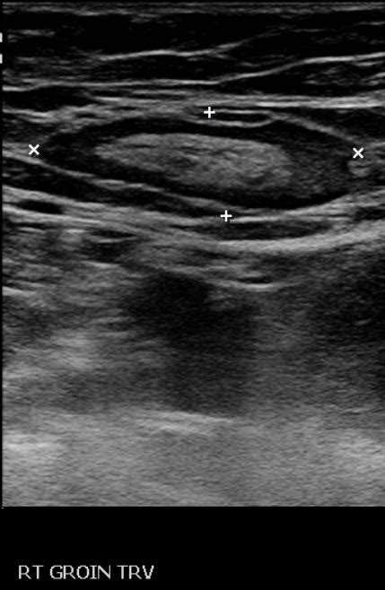 Lymph Node Ultrasound Angiologist