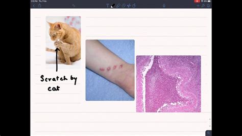 Stellate Granuloma In Cat Scratch Disease Youtube