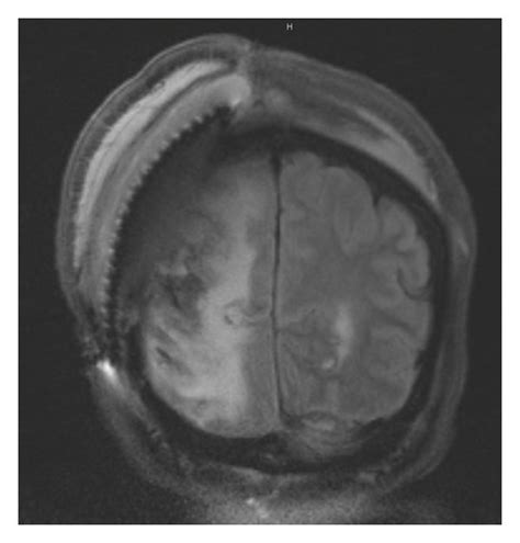 Mri Of The Brain Demonstrating A Decrease In The Subgaleal Fluid