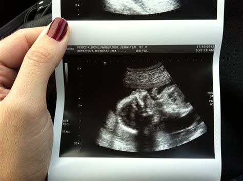 20 Weeks Ultrasound Girl