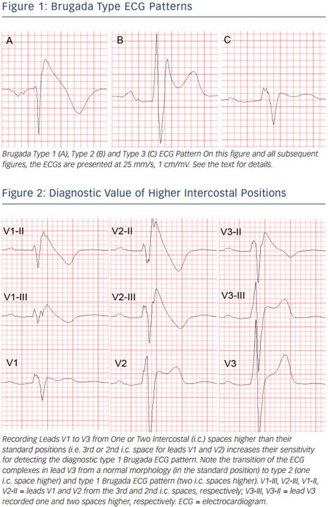 The Brugada Syndrome Diagnosis Clinical Implications And Risk