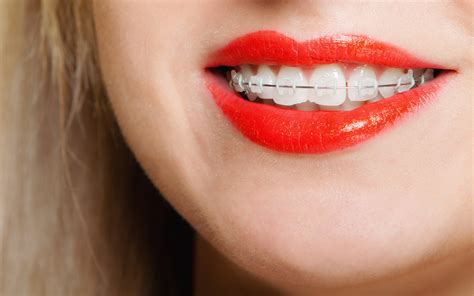 Braces And Straightening Teeth Different Methods Online Dentists