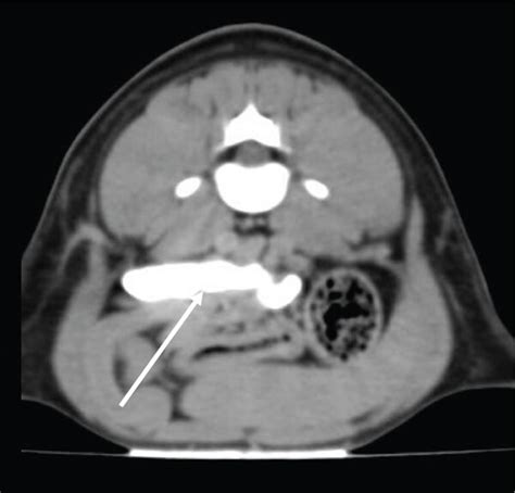 Postcontrast Computed Tomography Scan Images Using The Soft Tissue