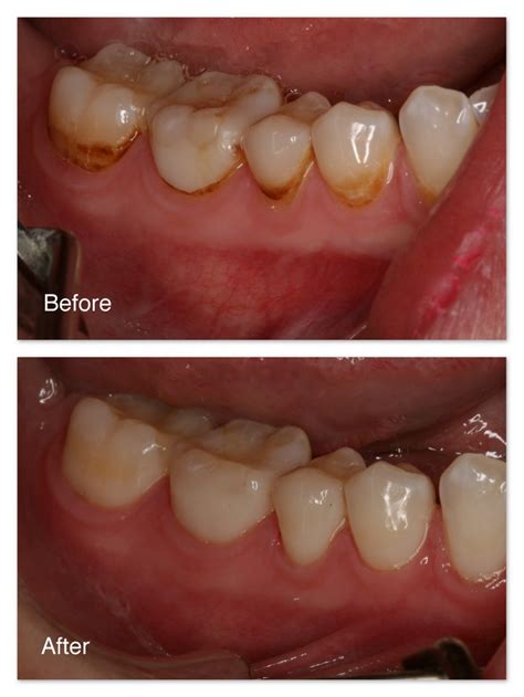 Removal Of Superficial Tooth Stains Gallery Dr Jack M Hosner Dds