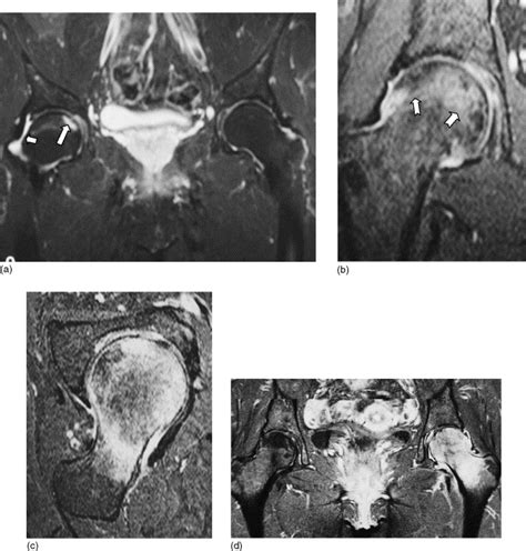 Mr Imaging Findings In Transient Osteoporosis Of The Hip European