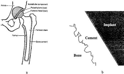 Total Hip Replacement With Bone Cement A Schematic Of Implant And