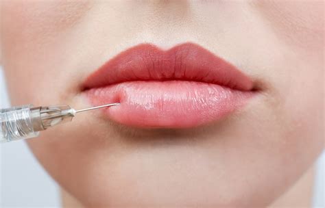 Dermal Fillers A Guide To Pain Reduction During Injection Justinboey