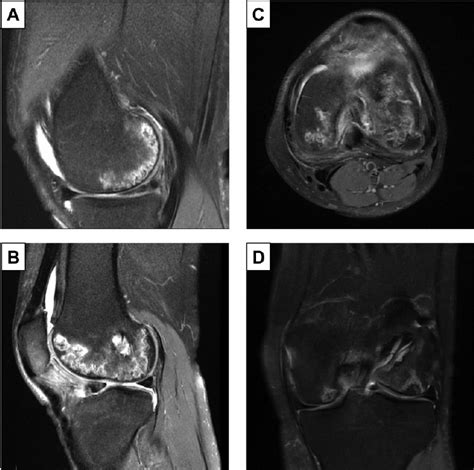 Fat Saturated T Weighted Magnetic Resonance Images Of The Knee Of Download Scientific Diagram