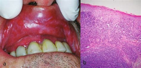 Lichenoid Lesions Of The Upper Lip A Retrospective Study Of 24 Cases