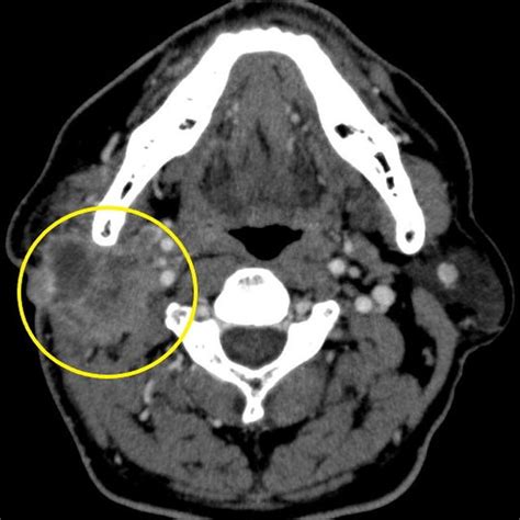 Ct Scan Demonstrates A Mass Lesion Located In The Right Parotid Gland