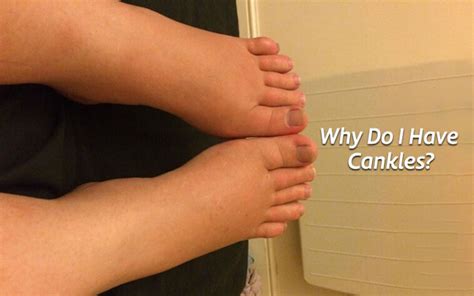 Causes And How To Get Rid Of Cankles With Exercise And Surgery