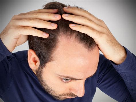 Hair Loss Due To Hormonal Imbalance How To Treat
