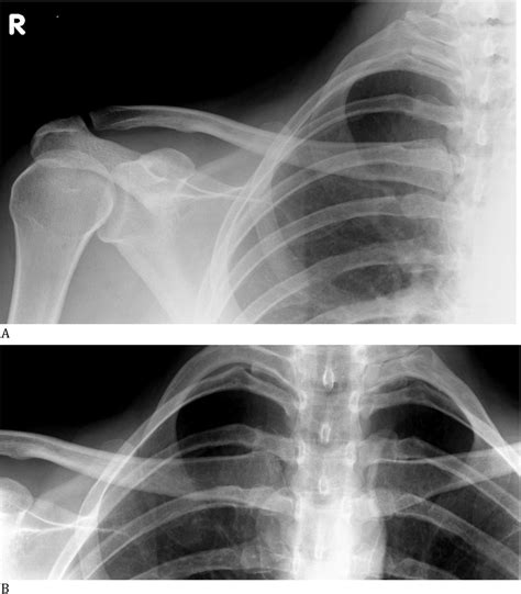 A Ap Radiograph Of Right Clavicle On Presentation Which Showed No