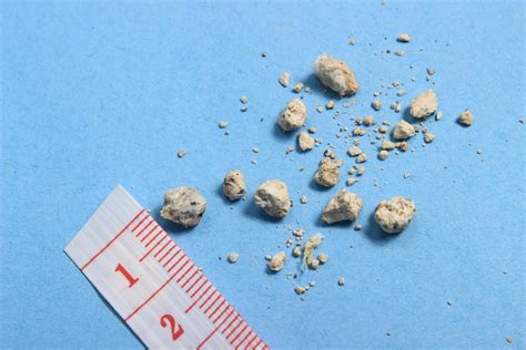 Kidney Stones Symptoms Causes And Treatment Au