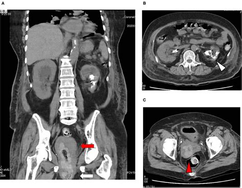 Frontiers Case Report Emphysematous Cystitis And Pyelonephritis
