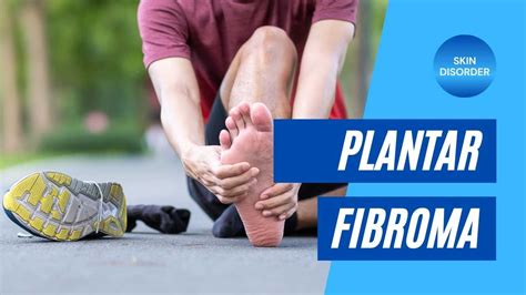 Virginias 1 Plantar Fibroma Treatment Achilles Foot And Ankle Rva