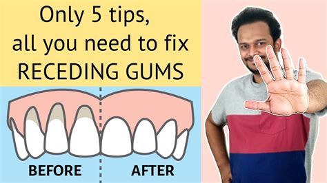 5 Habits To Naturally Heal Sensitive Teeth Reverse Receding Gums