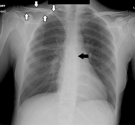 Malpositioned Right Internal Jugular Central Venous Catheter With An