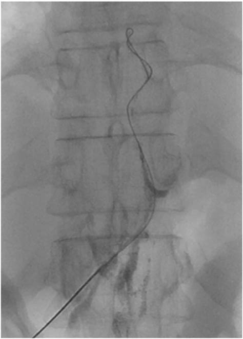 Lymphangiography And Thoracic Duct Embolization Both Antegrade And