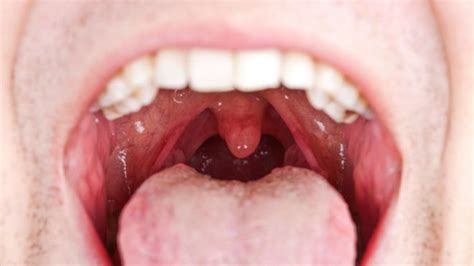 Mouth And Throat Cancer
