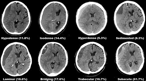 Frontiers Seizure After Surgical Treatment Of Chronic Subdural