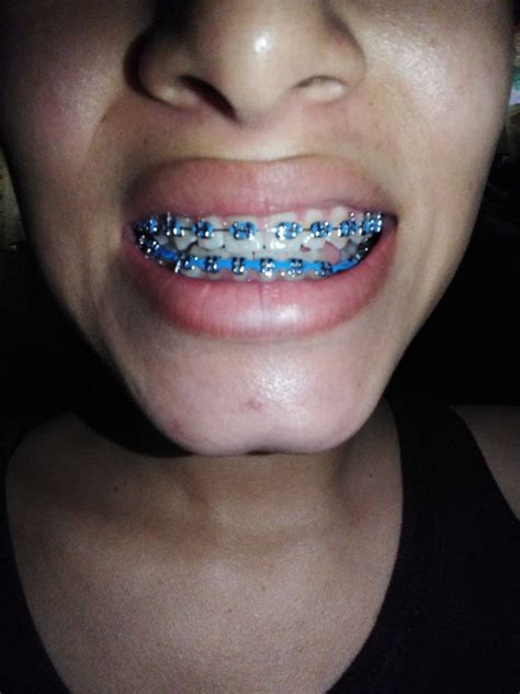 √ Aqua Color Braces