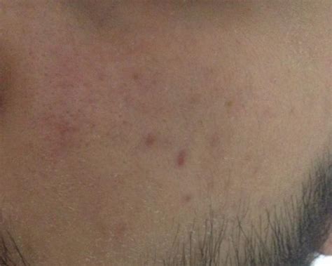 Flat Dark Spots After Acne Scar Treatments