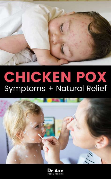 Chicken Pox Symptoms 4 Natural Ways To Find Relief Best Pure