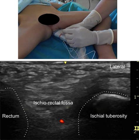 Ultrasound Guided Technique Of The Transperineal Pudendal Nerve Block
