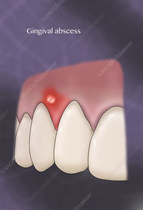 Gingival Abscess Illustration Stock Image C0366284 Science