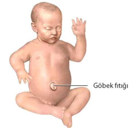 Bebeklerde Göbek Fıtığı Nedenleri Ve Tedavi Yöntemleri Bebek Rehberi