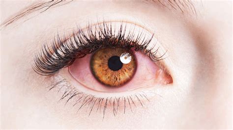 8 Treatments For Pink Eye Pink Eye Treatment Pink Eyes Eye Treatment