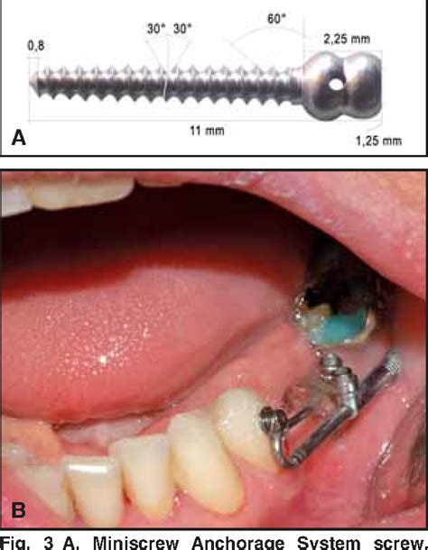 Figure 3 From Uprighting Mesially Inclined Mandibular Second Molars
