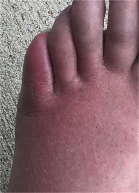 A Red Painful And Swollen Foot Overlying A Bone Erosion The