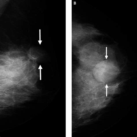 A 41 Year Old Female Presented With A Lump In Her Left Breast