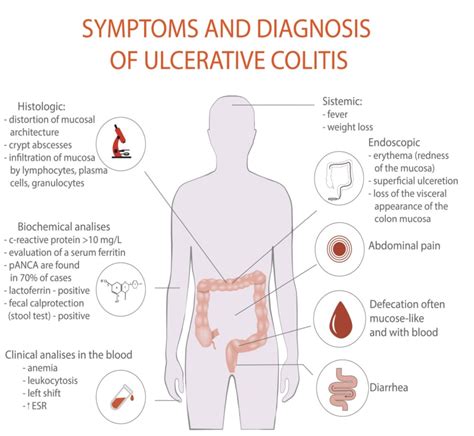 Ulcerative Colitis How Much Blood Is Too Much